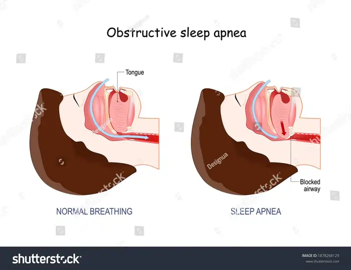 Sleep Apnea and Aging: The Hidden Connection to Accelerated Aging 2 Understanding Sleep Apnea and Its Prevalence